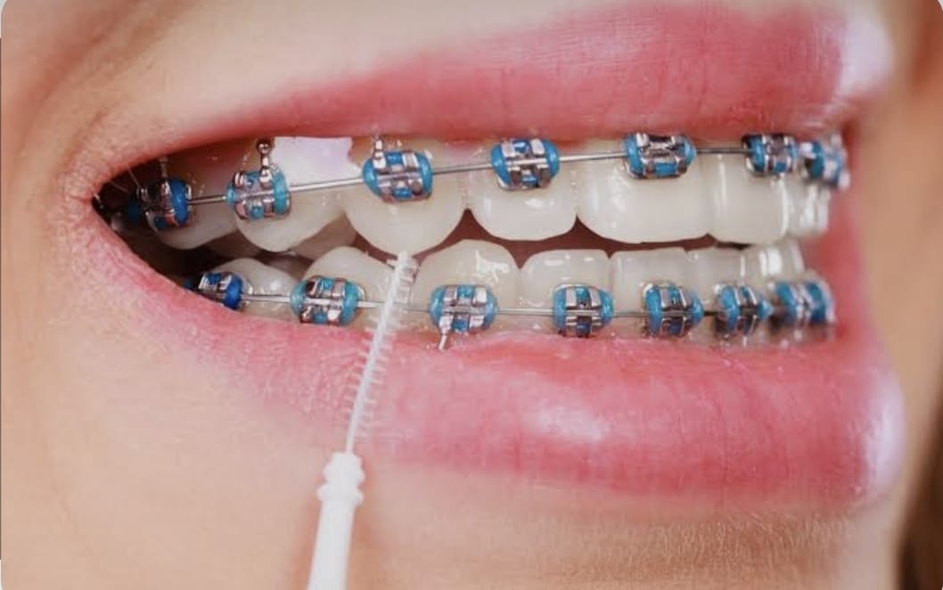 Aparelho ortodôntico fixo metálico instalado nos dentes, com escova interdental na higienização — o tipo de aparelho é definido na avaliação ortodôntica