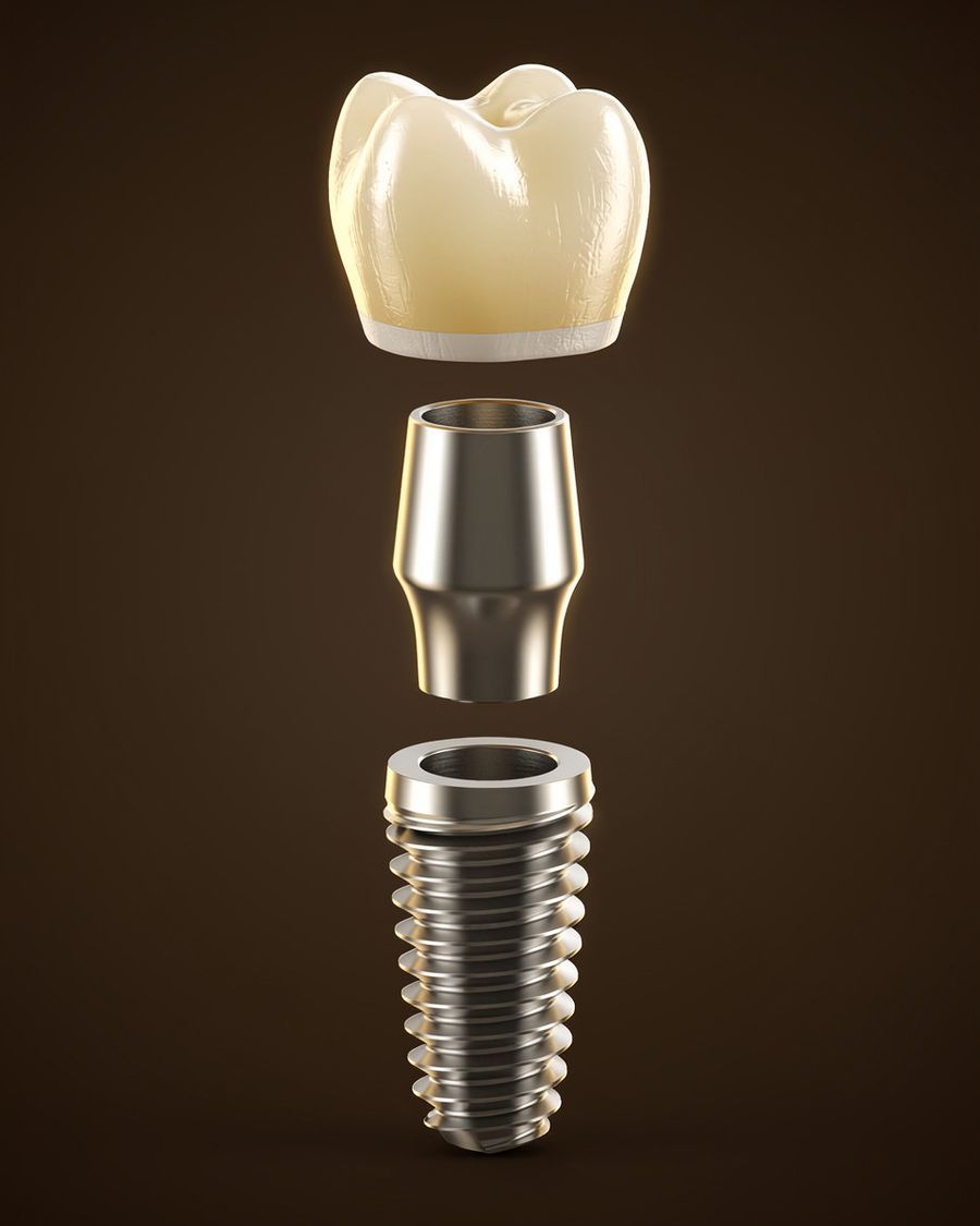 Ilustração 3D de implante dentário em três partes: pino de titânio, conector e coroa de cerâmica
